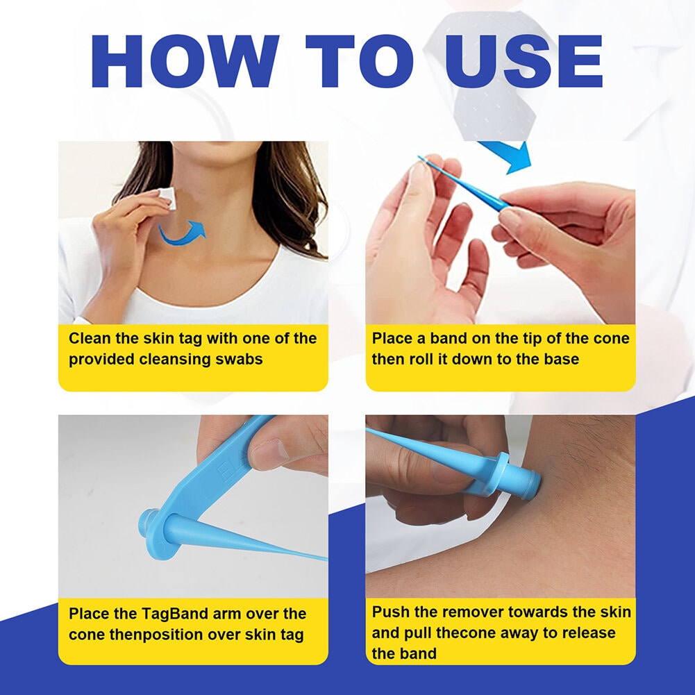 Skin-Tag-Entfernungskit-2-in-1 Silikonbandligationssystem für den sicheren Heimgebrauch-4