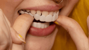Sofortige Lächelverwandlung mit Snap on Smile Veneers 6